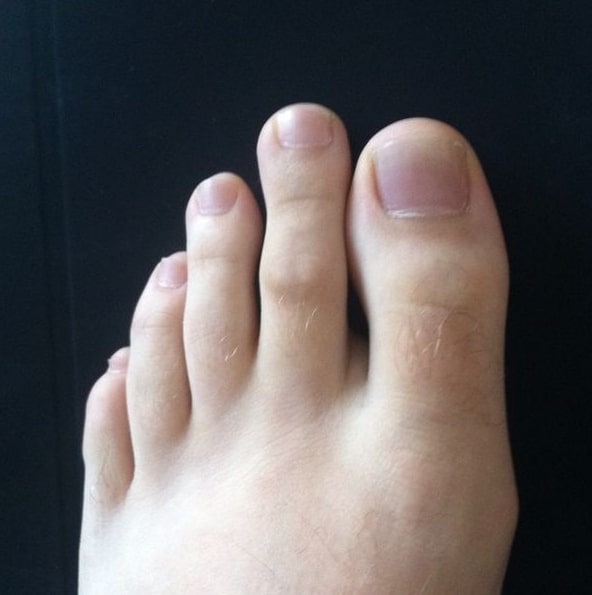 Photo: a left foot with a long second toe. Credit: Jrockets; Wikimedia Commons.