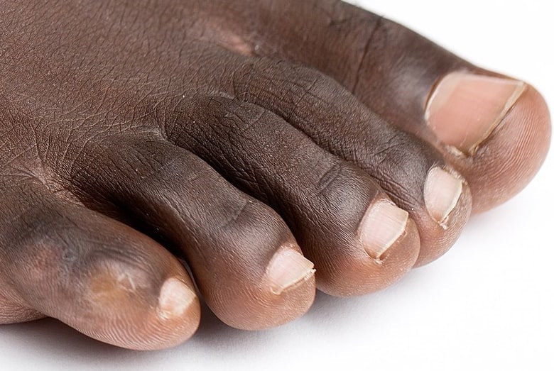 Photo: toes of a right foot. Credit: Genusfotografen (Tomas Gunnarsson); Wikimedia Commons.